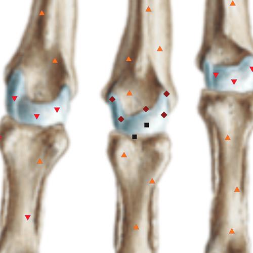 Three-dimensional NLS-graphy of joints in diagnostics of early ...